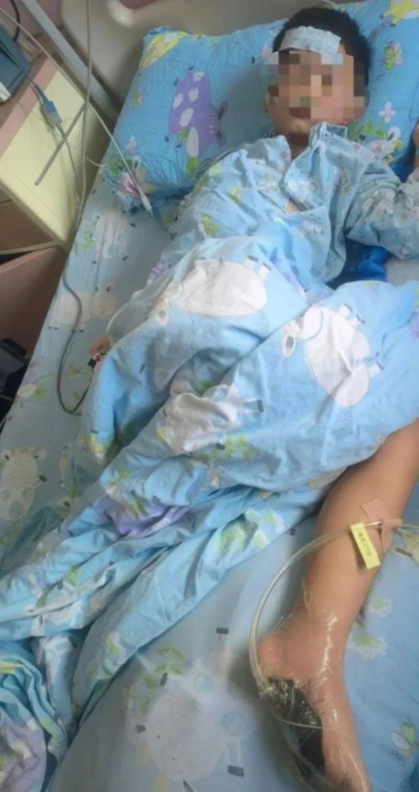 配资股网站 6岁男孩海边赤脚玩耍，踩到死鱼后发烧进ICU